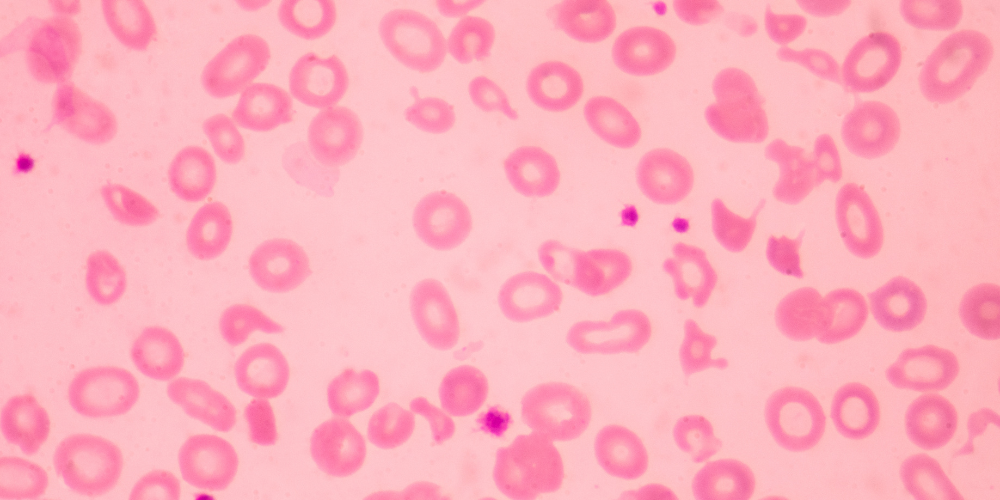Thalassemia4