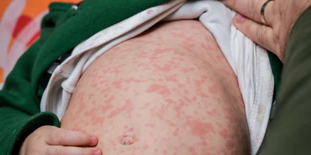 Baby measles2