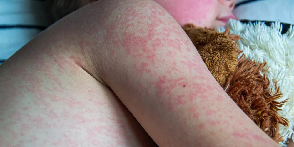 Baby measles3