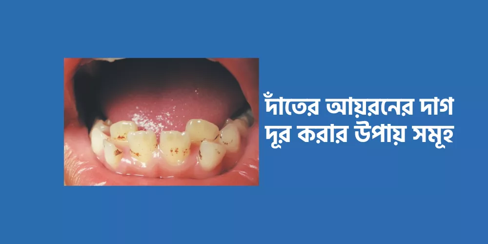 Dental iron1
