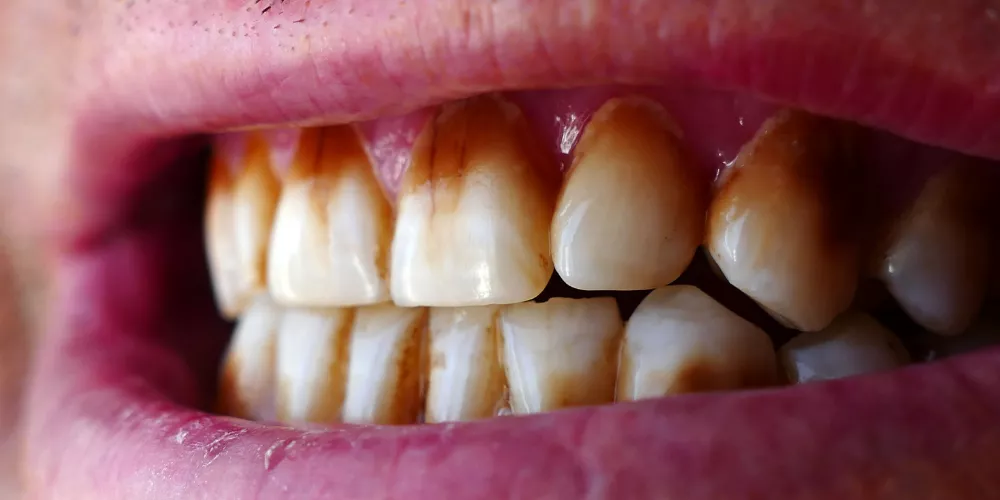 Dental iron2