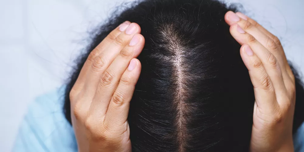 Excessive hair loss in girls3