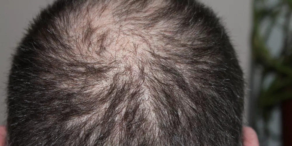 Hair loss2
