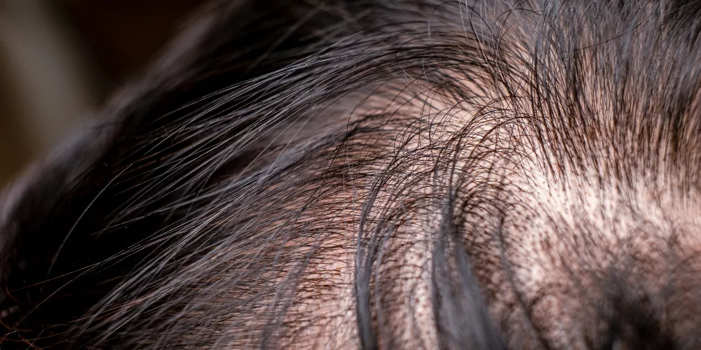 Hair loss3