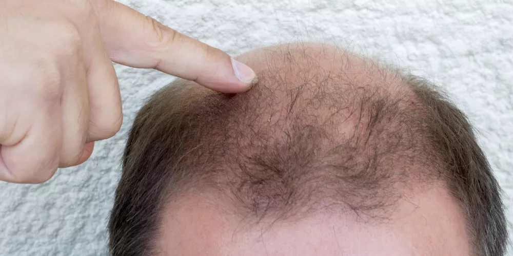 Hair loss4