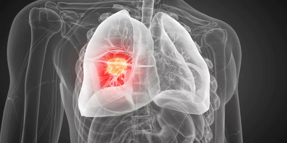 Lungs3