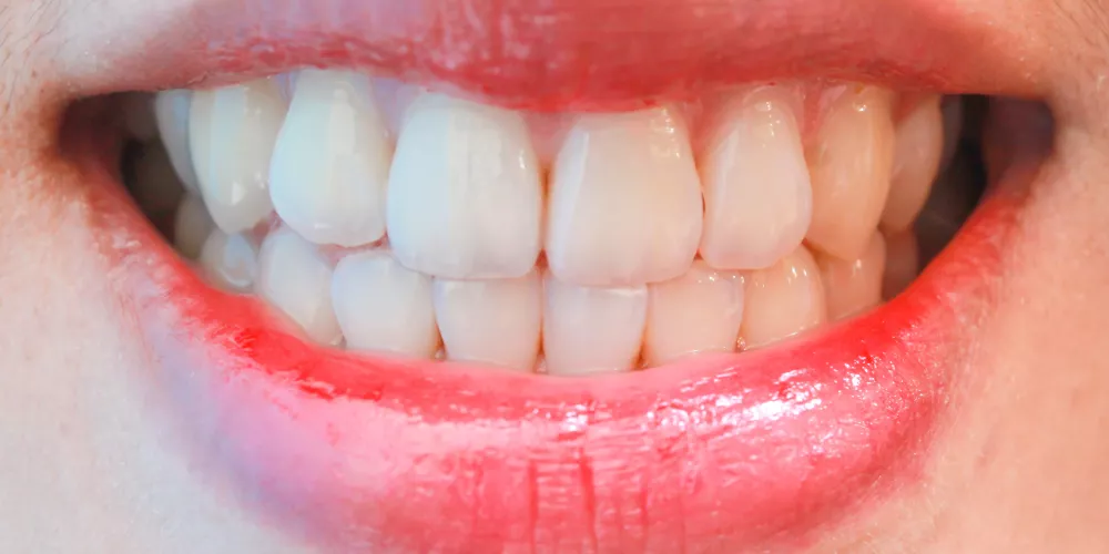 Teeth2