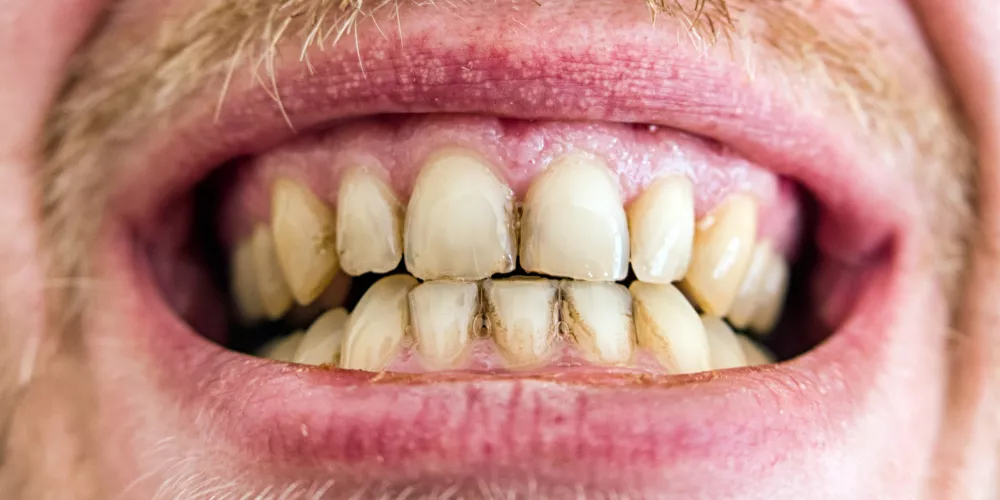 Teeth3