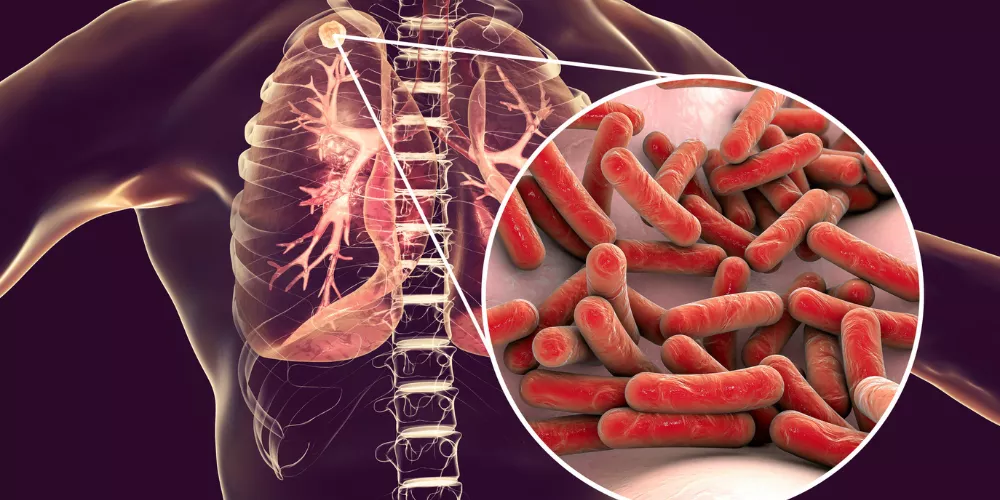 Tuberculosis2