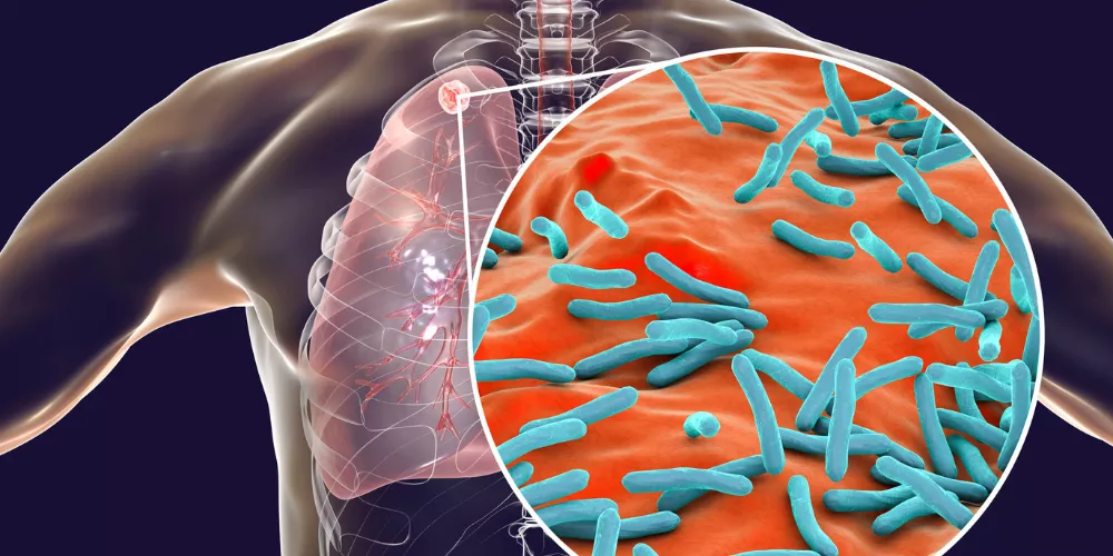 Tuberculosis3
