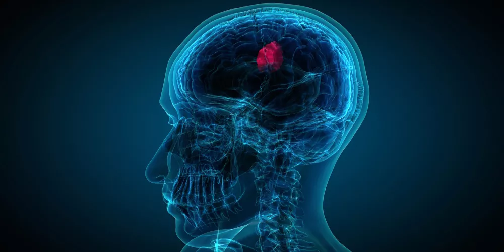 Tumor2