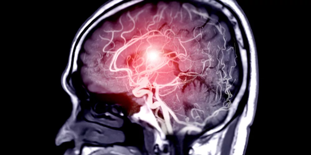 Tumor3