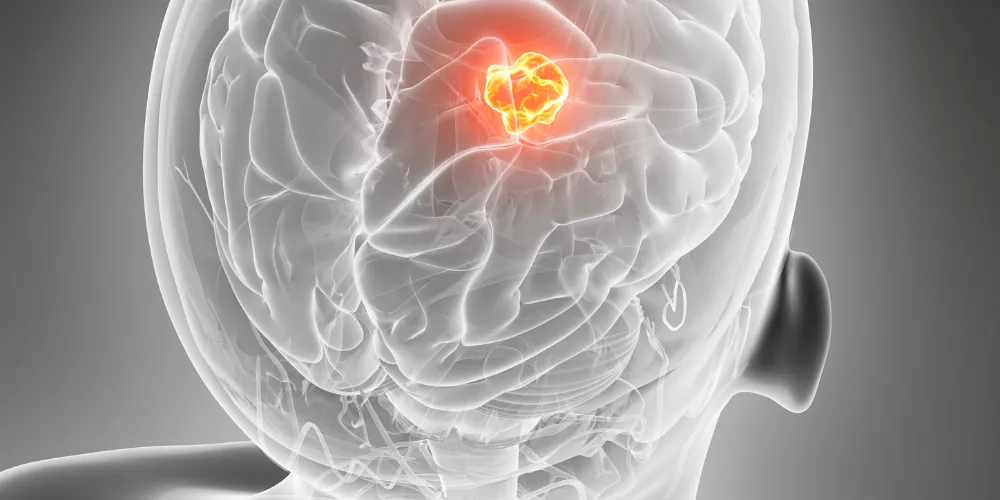 Tumor4