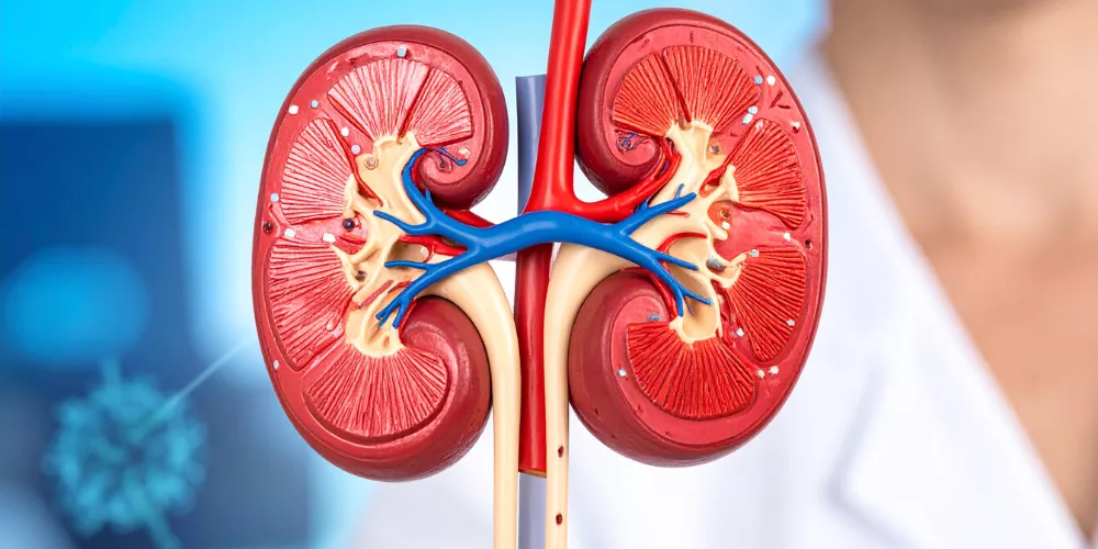 Kidney stones3